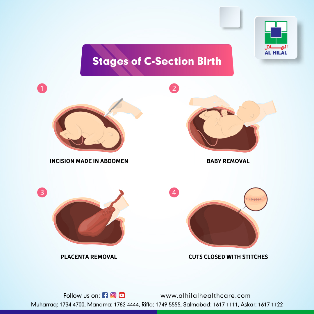 compound presentation cesarean section