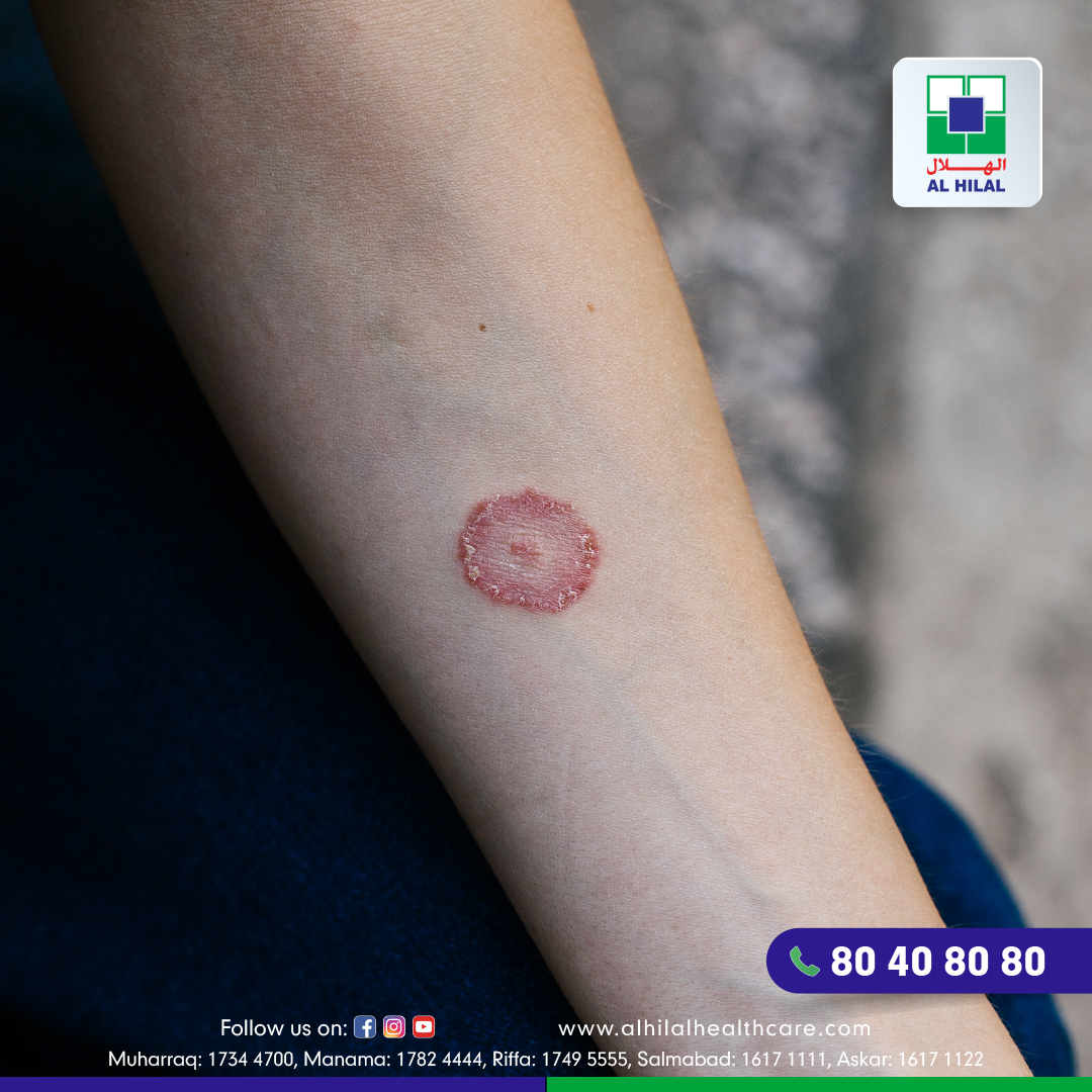 What are the Symptoms of Ringworm?