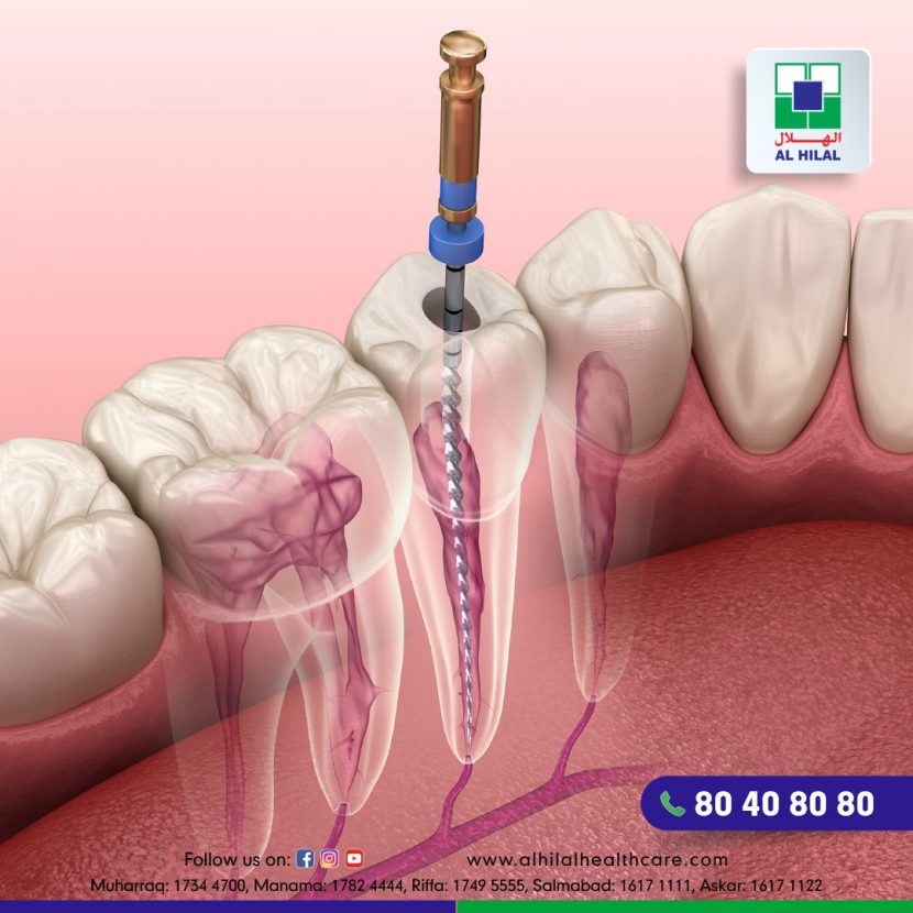 Root Canal Treatment Everything you need to know.