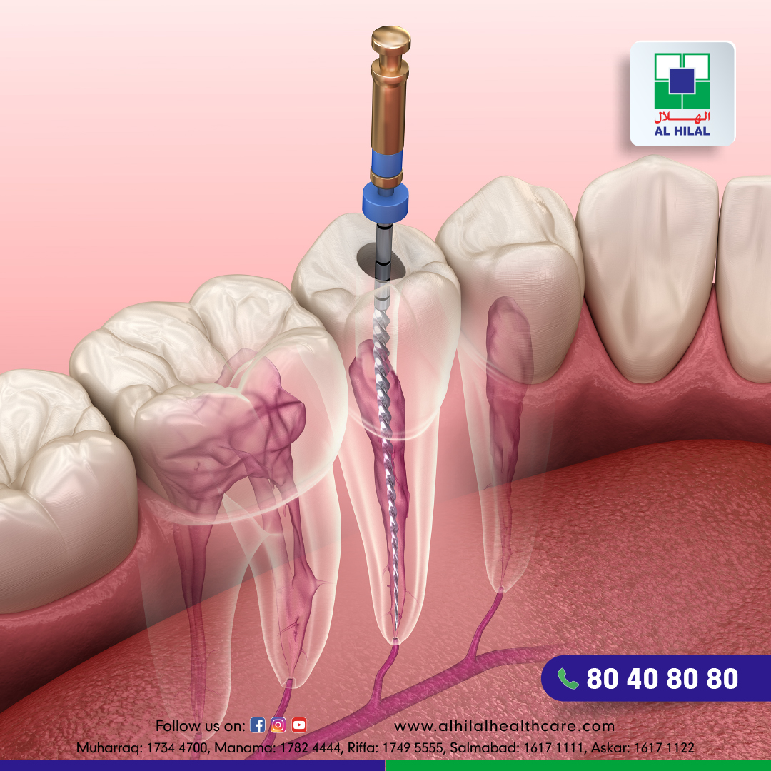 Root Canal Treatment Everything You Need To Know root-canal-treatment-everything-you-need-to-know