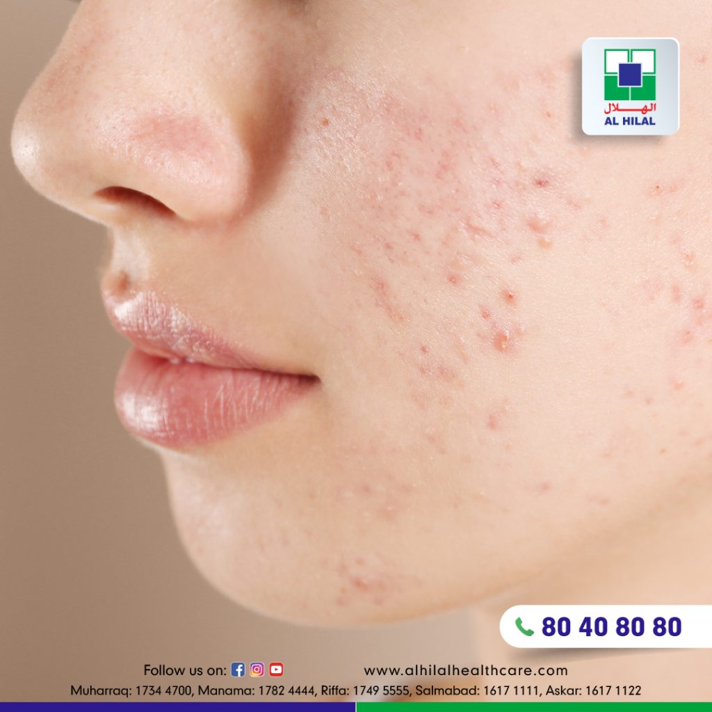 faces with acne vulgaris