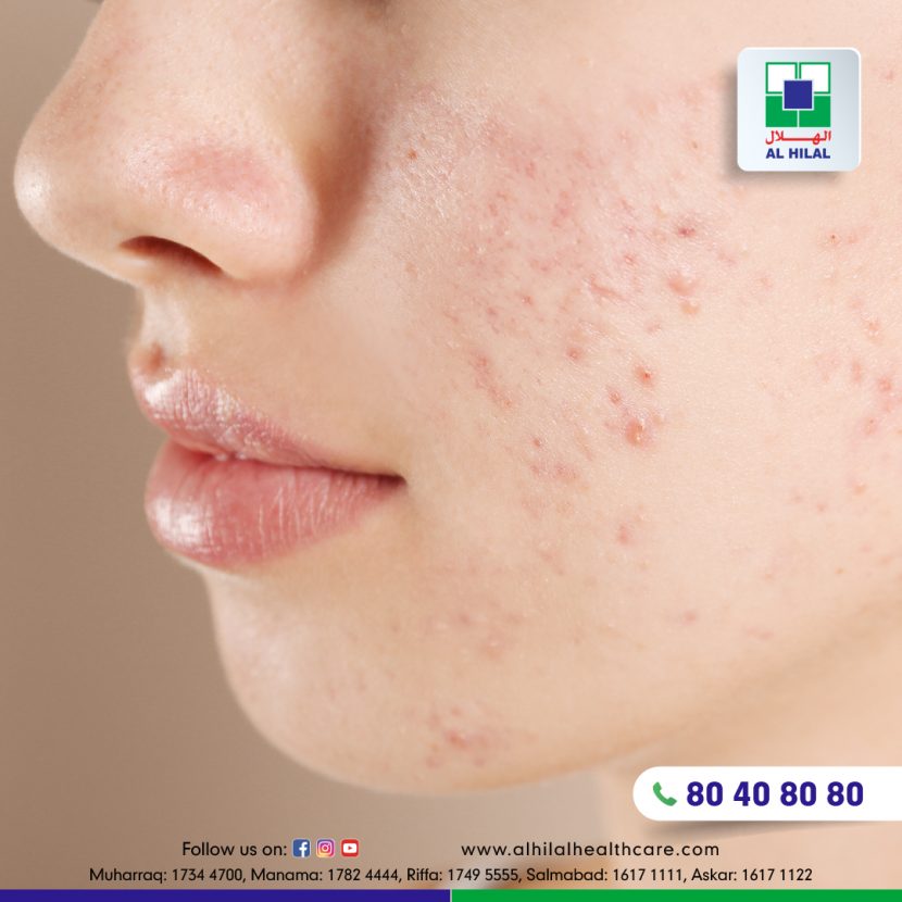 Understanding Acne Vulgaris Symptoms, Causes & Treatments